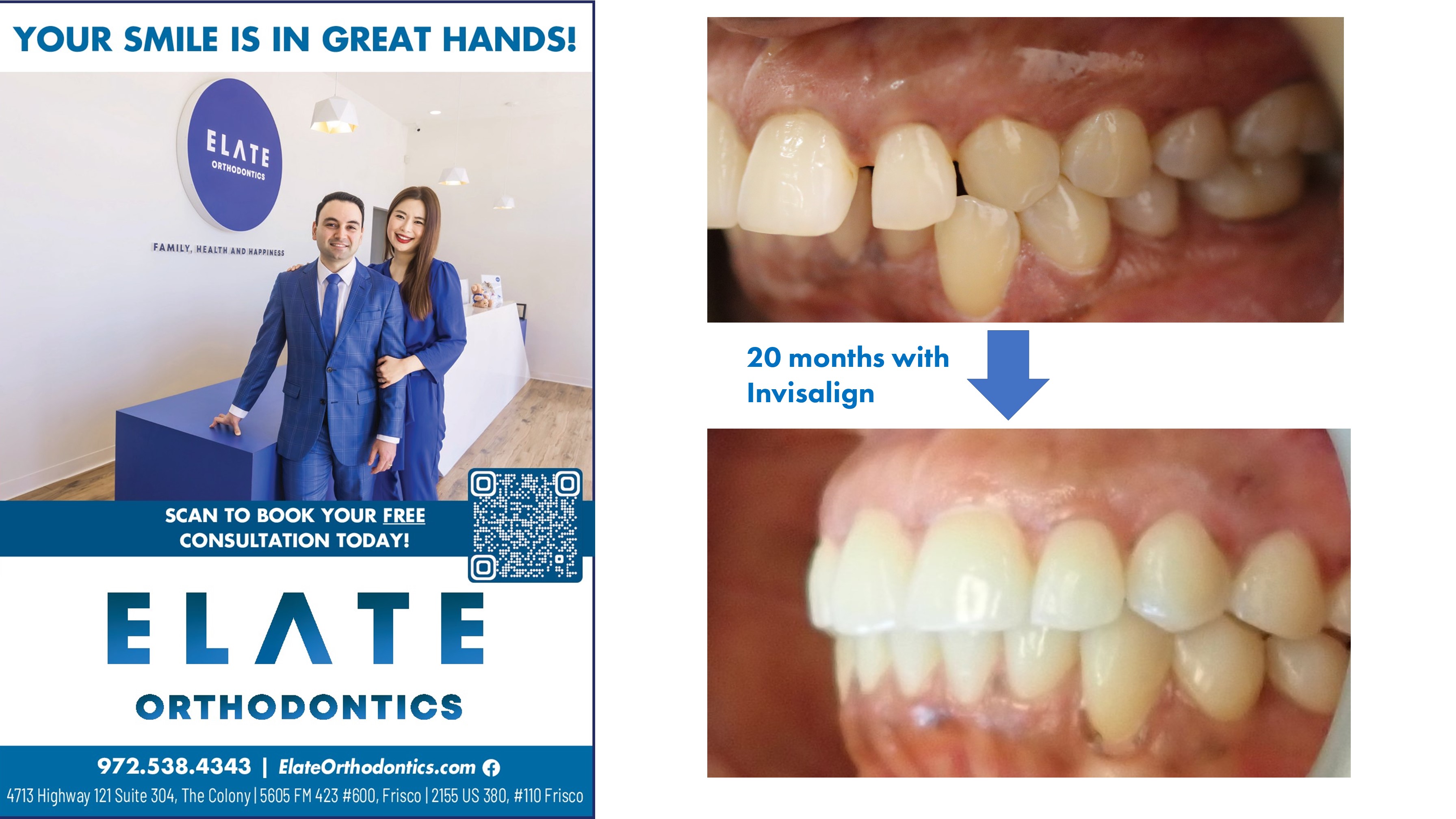 Teen smiling after clear aligner treatment